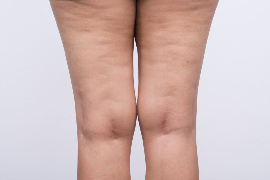 woman with cellulite on her legs