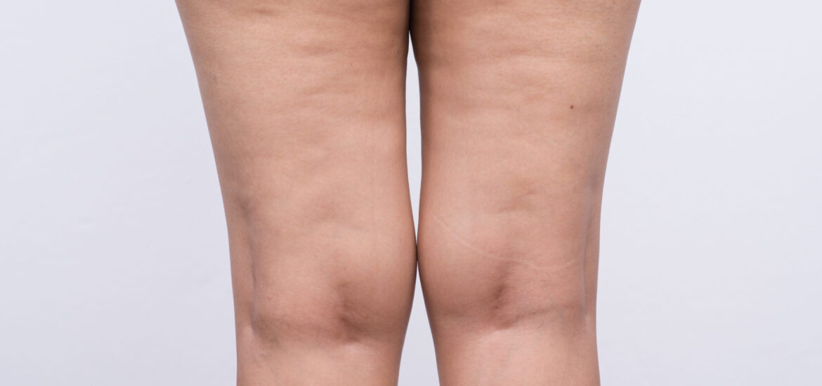 shutterstock_431778217 woman with cellulite on her legs