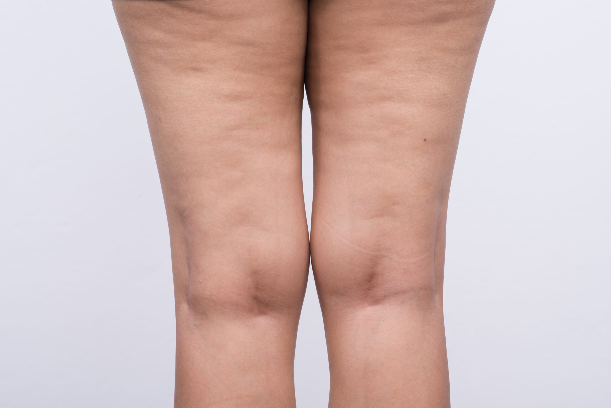 woman with cellulite on her legs
