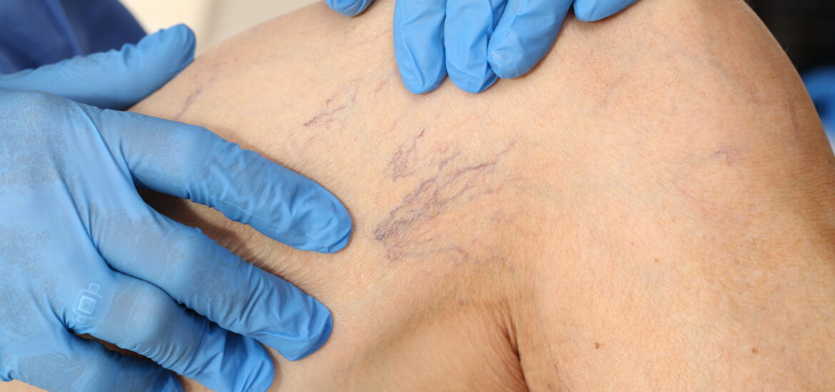 shutterstock_470469407 Microsclerotherapy treatment for Thread or Spider Veins in the leg vie aesthetics