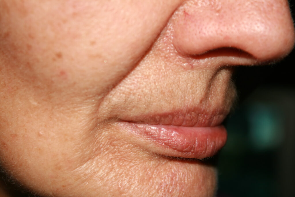 Person with deep nasolabial folds or smile lines