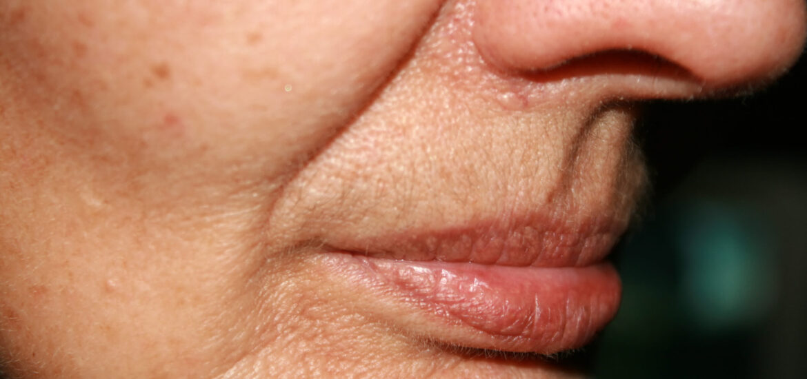 shutterstock_550871200 Person with deep nasolabial folds or smile lines