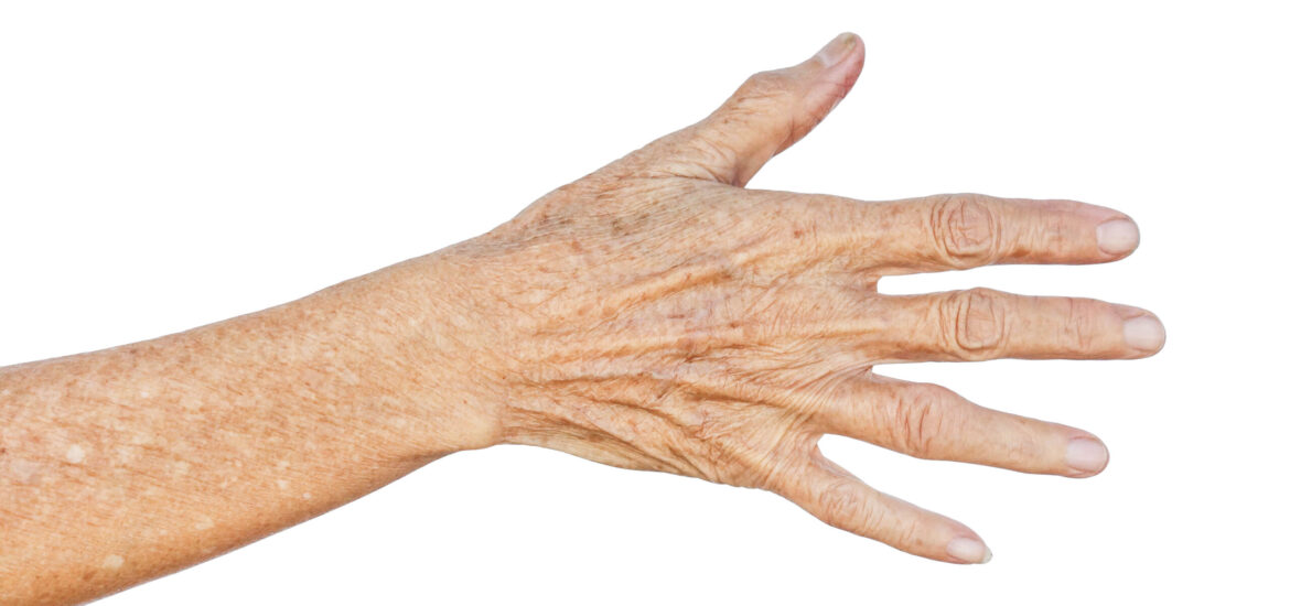 shutterstock_567994510 Person is concerned about ageing hands and thin skin