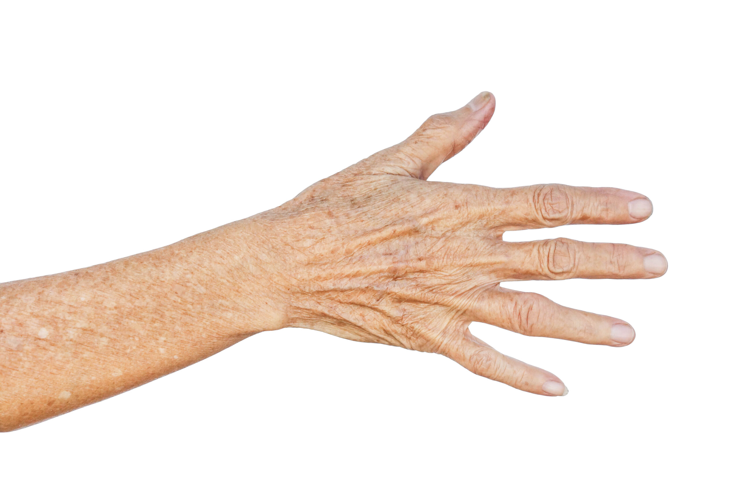 Person is concerned about ageing hands and thin skin