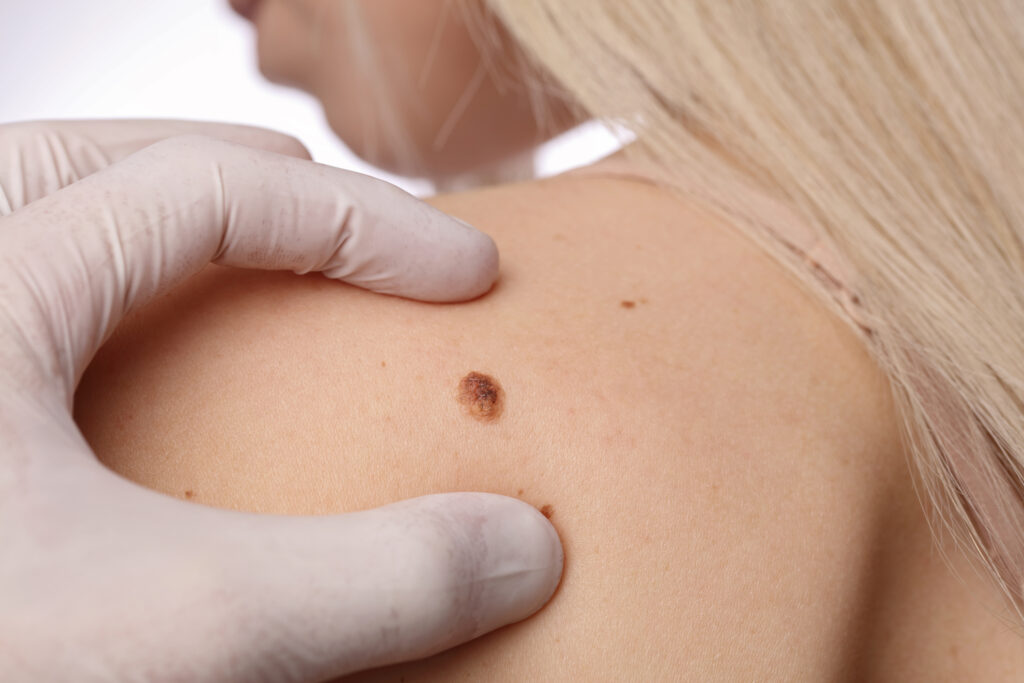 Skin mole on a woman's shoulder is examined by a doctor for mole removal treatment