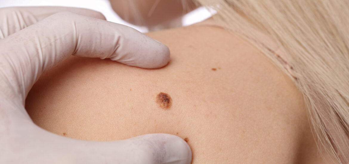 shutterstock_583873564 Skin mole on a woman's shoulder is examined by a doctor for mole removal treatment