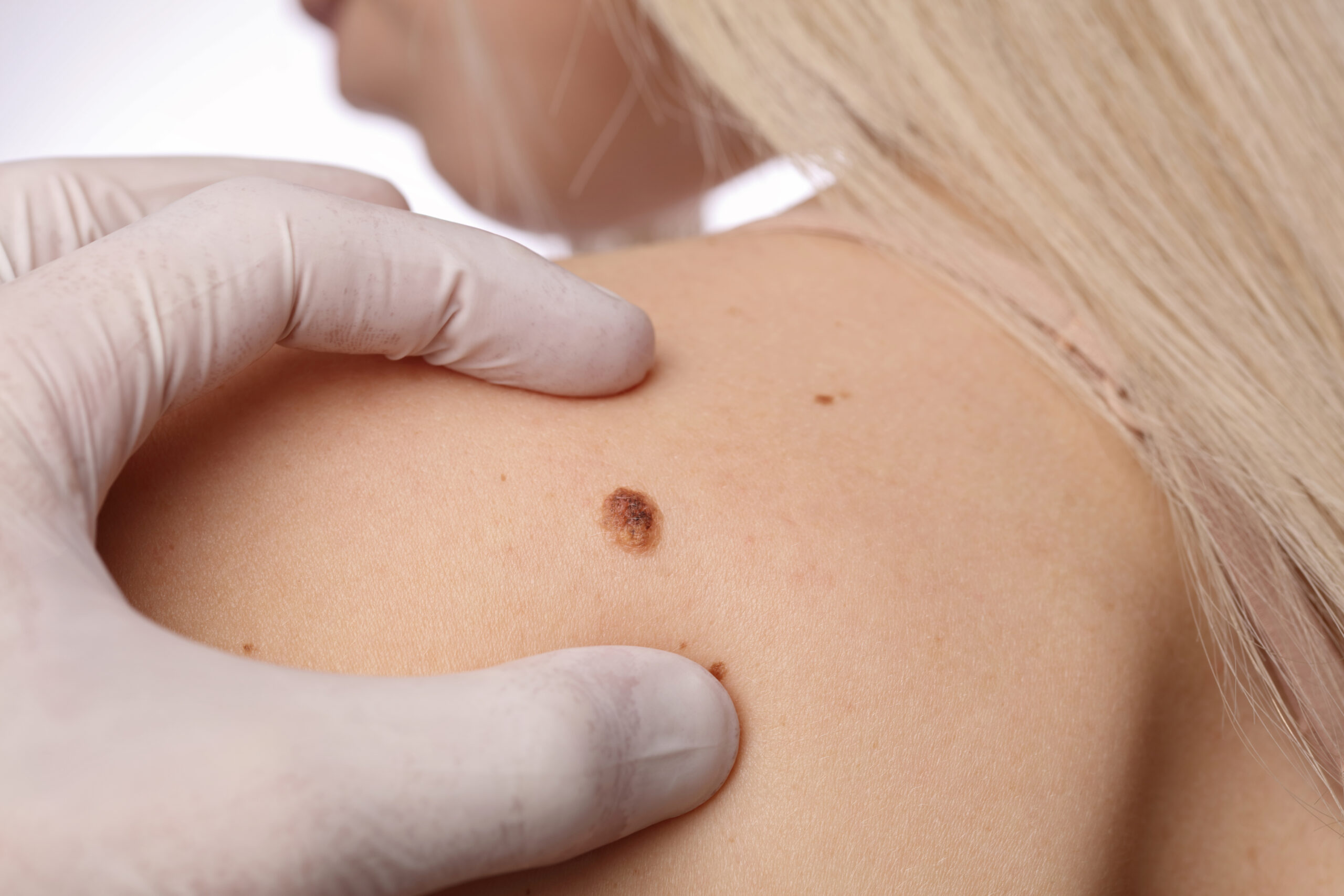 Skin mole on a woman's shoulder is examined by a doctor for mole removal treatment