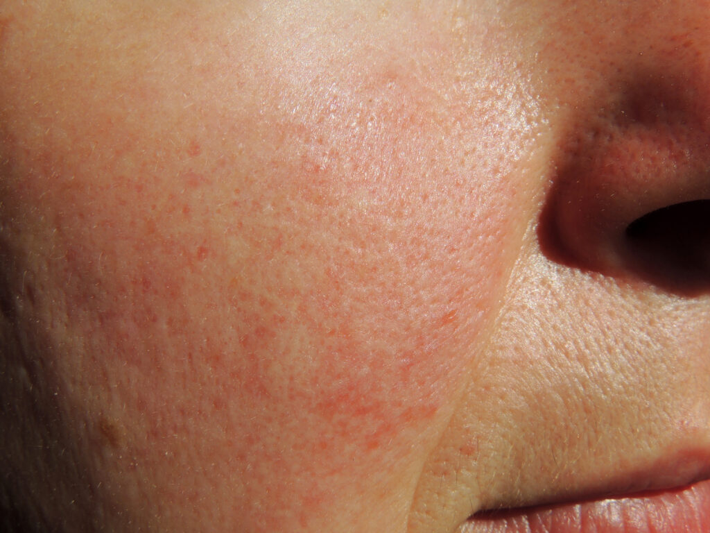 Person suffering from the skin condition rosacea on their cheeks