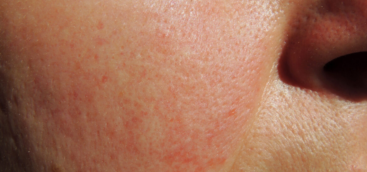 shutterstock_674660905 Person suffering from the skin condition rosacea on their cheeks