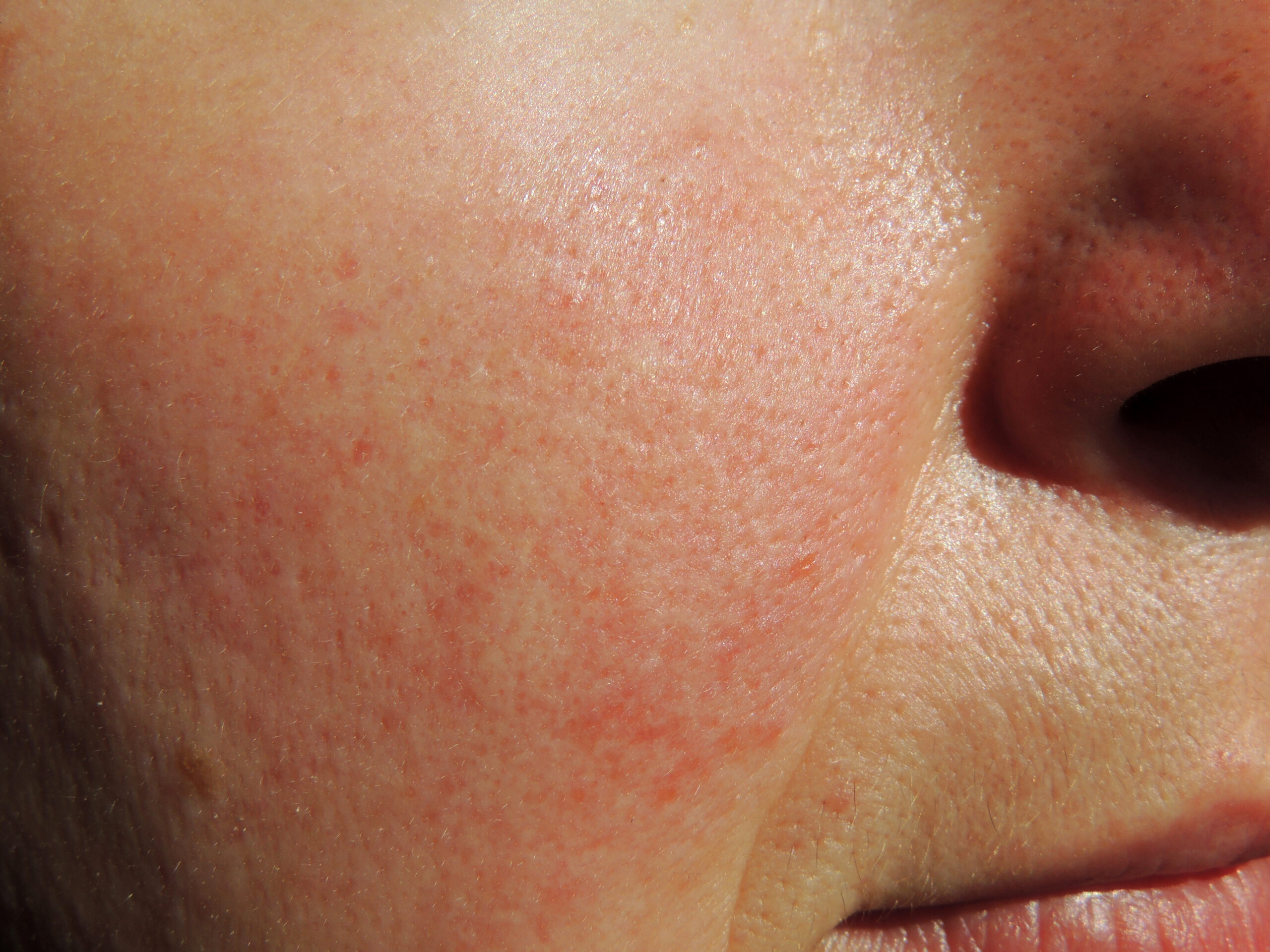 Person suffering from the skin condition rosacea on their cheeks