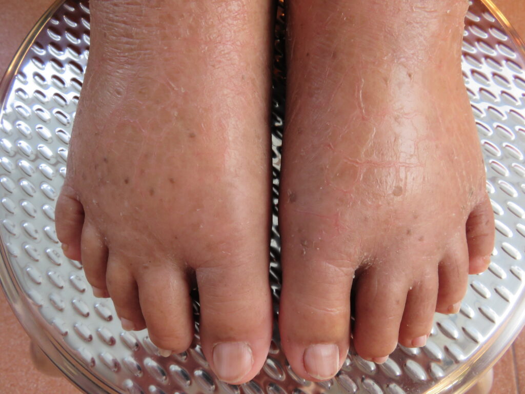 water retention or oedema in a person's feet