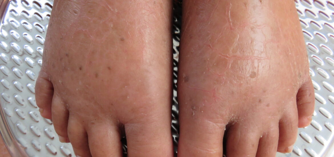 shutterstock_783582580 water retention or oedema in a person's feet