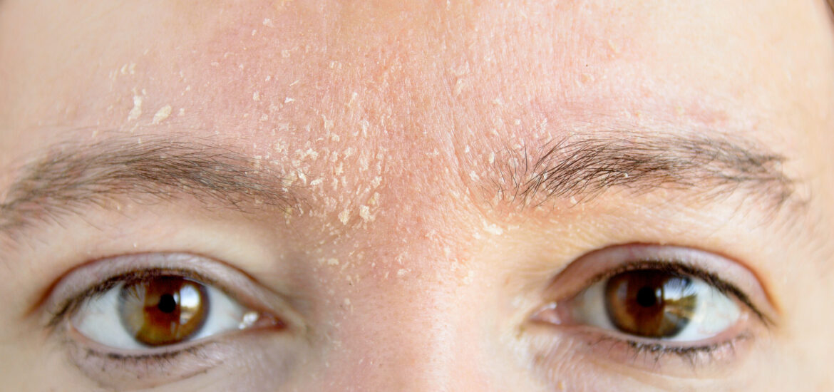 shutterstock_793490287 woman suffering from flaky, dry skin on her face