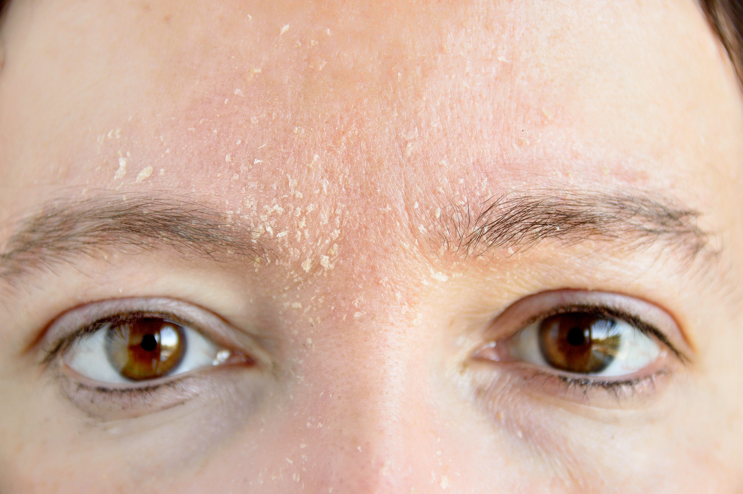woman suffering from flaky, dry skin on her face